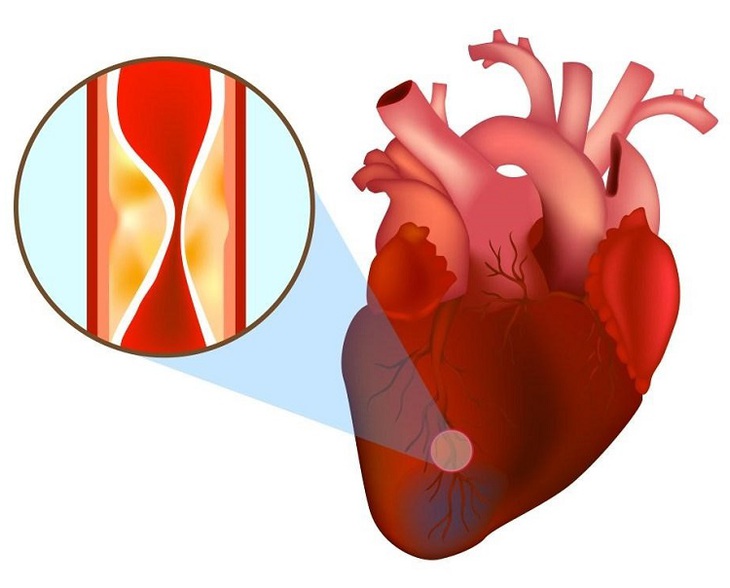 Nhồi máu cơ tim cấp: Triệu chứng, Điều trị, Phòng ngừa - Bệnh viện Đa khoa  Vạn Hạnh
