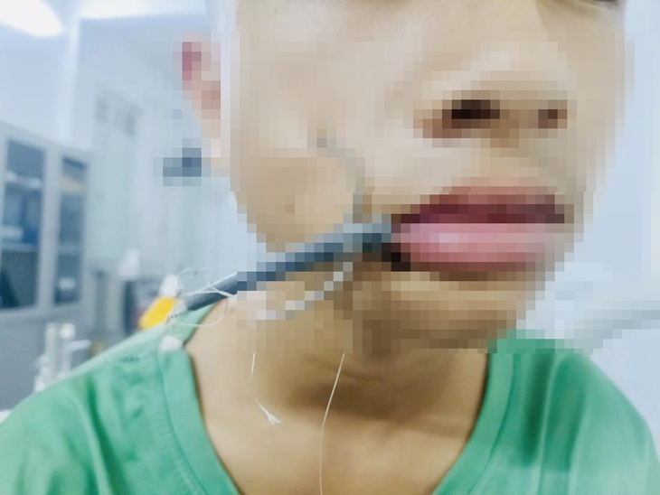 Đi câu cá, lưỡi câu móc vào má- Ảnh 1.