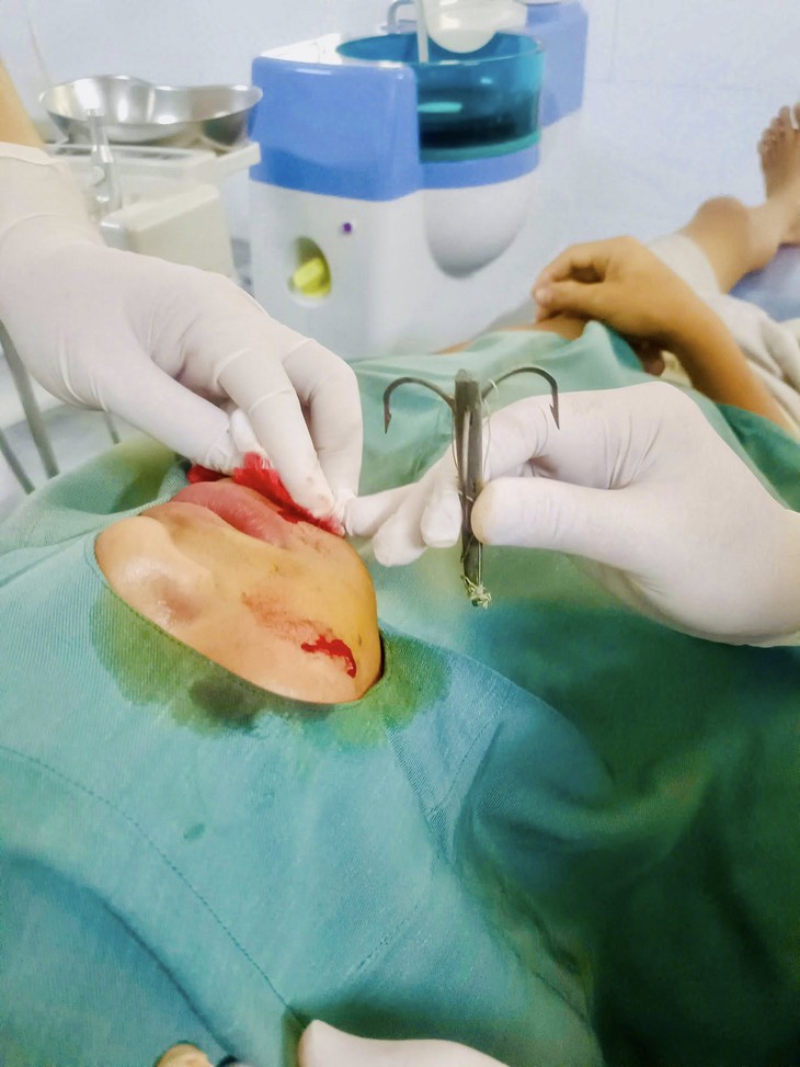 Đi câu cá, lưỡi câu móc vào má- Ảnh 2.