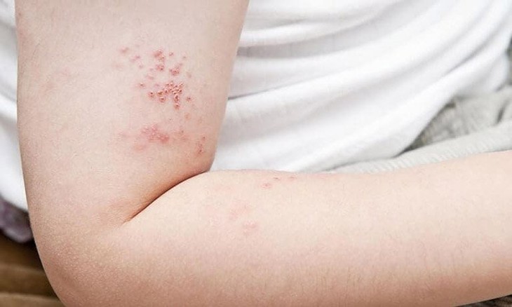 Điều trị đau dây thần kinh sau zona kéo dài- Ảnh 1.