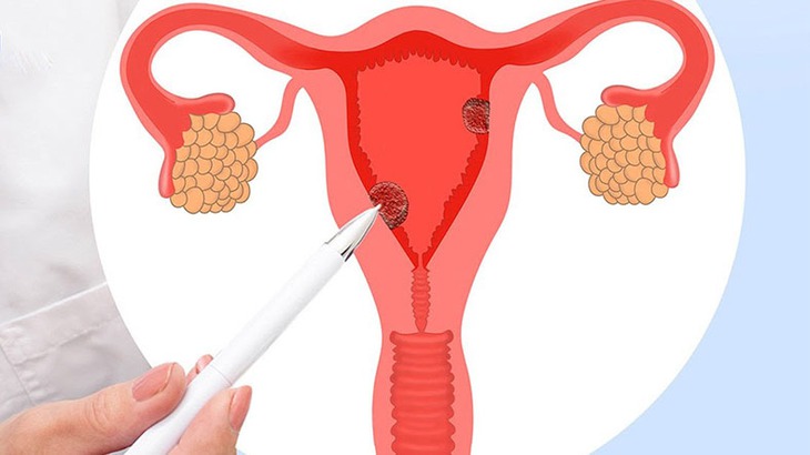 Hội chứng buồng trứng chuyển hóa đa nội tiết - tên gọi mới của hội chứng buồng trứng đa nang- Ảnh 1. Hội chứng buồng trứng chuyển hóa đa nội tiết - tên gọi mới của hội chứng buồng trứng đa nang- Ảnh 1.