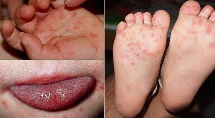 Khánh Hòa đã ghi nhận 2.254 ca tay chân miệng, bác sĩ khuyến cáo điều cần nhớ để phòng bệnh- Ảnh 1.