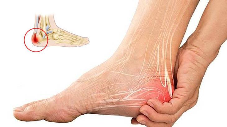 Biểu hiện điển hình khi mắc gai gót chân, đừng chủ quan với những cơn đau ở bàn chân- Ảnh 1.