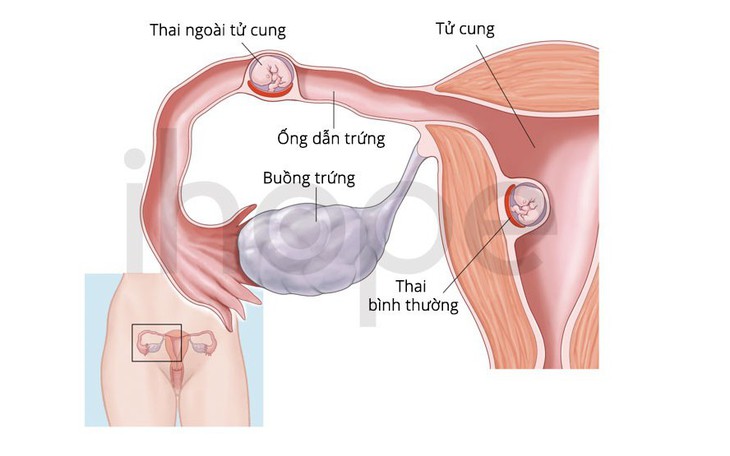 Cứu sản phụ mắc ca thai trong tử cung đồng thời thai ngoài tử cung ổ bụng hiếm gặp- Ảnh 3.