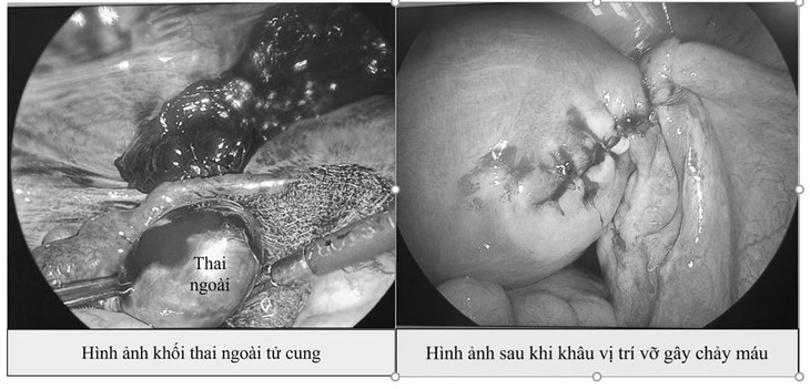 Hiếm gặp: Vừa có thai trong tử cung vừa có thai ngoài tử cung- Ảnh 1.