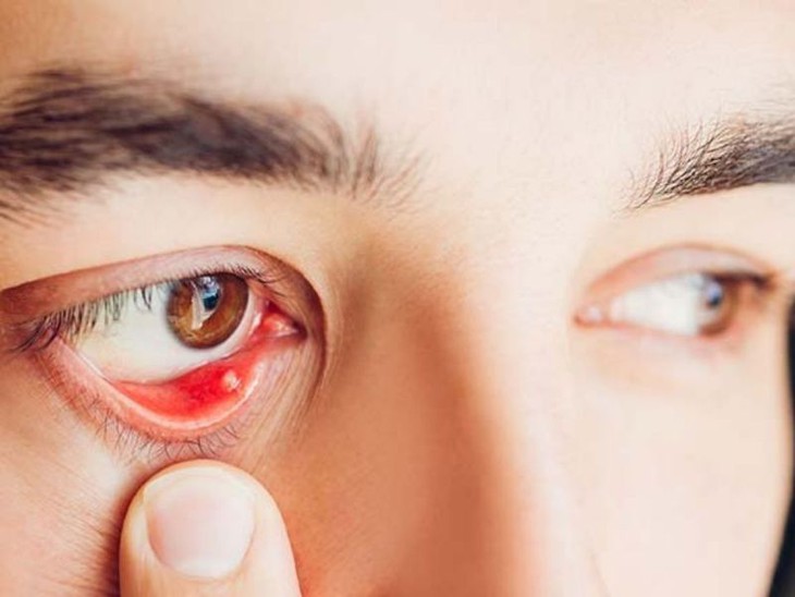 Nguyên nhân gây cộm mắt và cách khắc phục- Ảnh 1.
