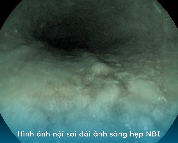 Bệnh viện Hoàn Mỹ Vinh: phát hiện nhiều trường hợp tiền ung thư thông qua nội soi- Ảnh 2.
