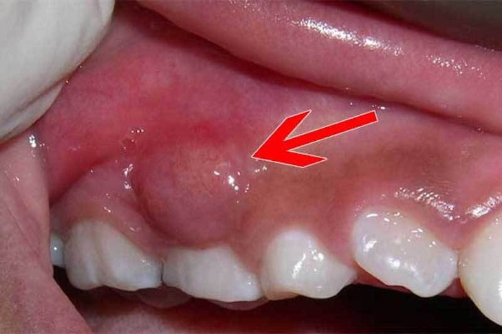 Cảnh báo biến chứng nguy hiểm của áp xe răng- Ảnh 1.