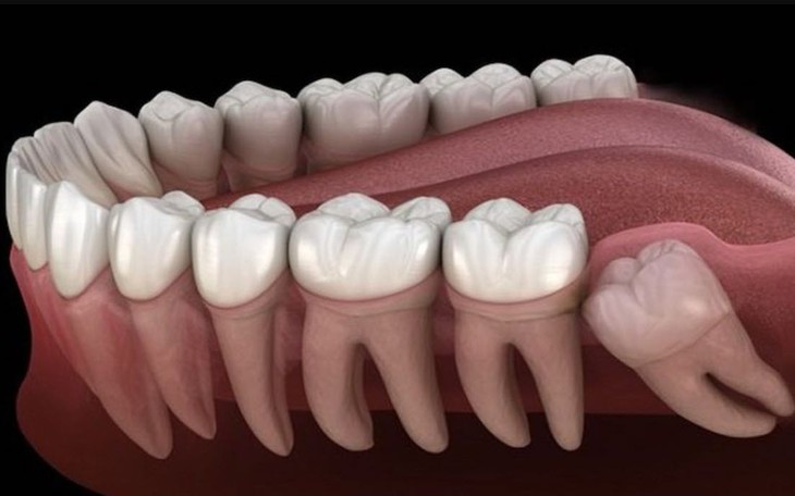 Nhổ răng khôn có nguy hiểm không, khi nào cần nhổ?- Ảnh 1.