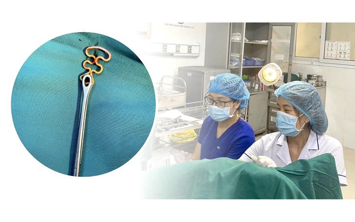 Cụ bà 70 tuổi để quên vòng tránh thai suốt 40 năm trong tử cung- Ảnh 3.