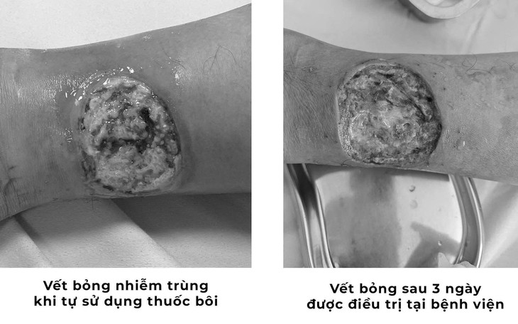 Đổ xăng khi đốt rác, người phụ nữ bị bỏng nhiều vùng trên cơ thể- Ảnh 2.