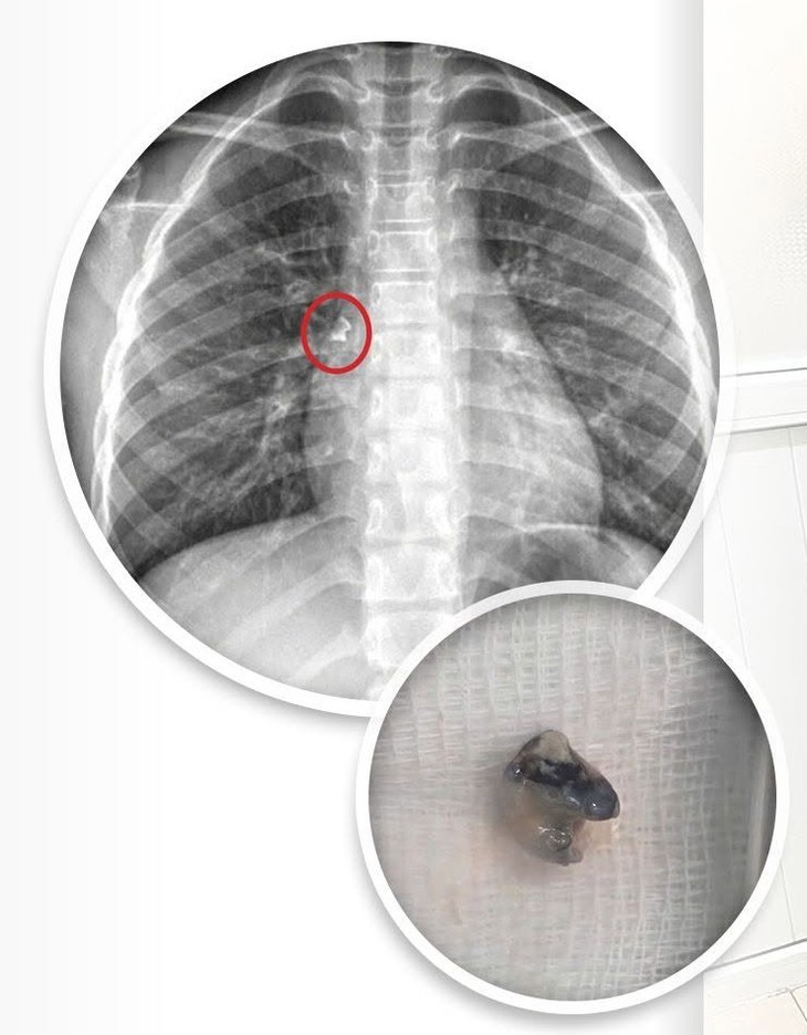 Chiếc răng 'đi lạc' vào phế quản, bé trai 9 tuổi phải nội soi cấp cứu- Ảnh 1.