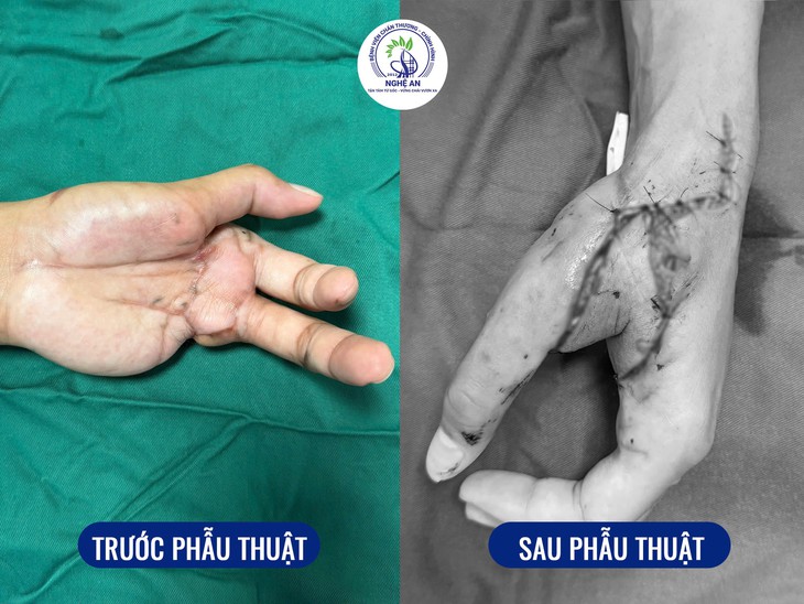 Bước tiến trong phẫu thuật vi phẫu: Chuyển vạt SCIP tự do được triển khai tại Nghệ An- Ảnh 2.