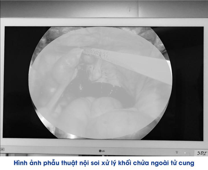 Liên tiếp cứu sống nhiều phụ nữ chửa ngoài tử cung vỡ tại Bệnh viện Đa khoa Khu vực Vân Đồn - Ảnh 2.