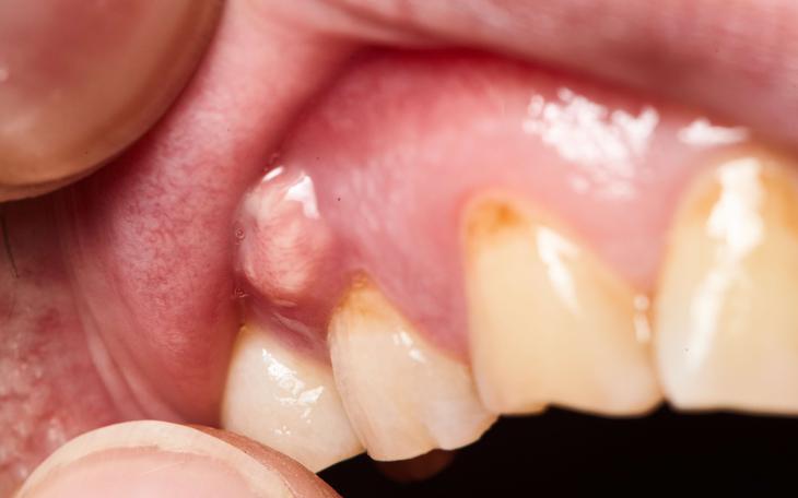 Vì sao răng bị ê buốt đột ngột khi ăn đồ nóng lạnh?- Ảnh 2.