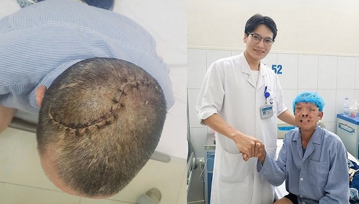 90 phút 'nghẹt thở' cứu người đàn ông bị vỡ lún sọ, tràn máu màng phổi- Ảnh 1.