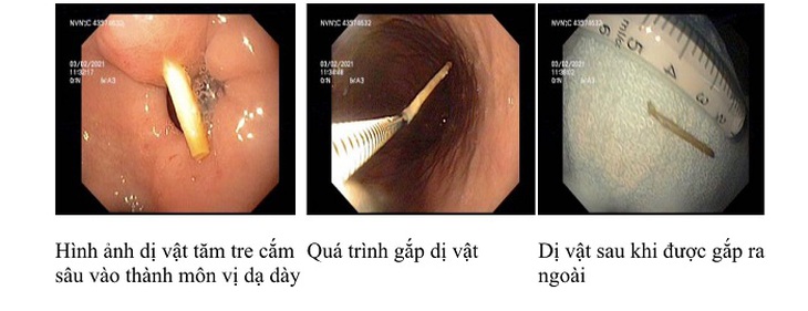 Thói quen ngậm tăm sau ăn hệ lụy khó lường- Ảnh 1.