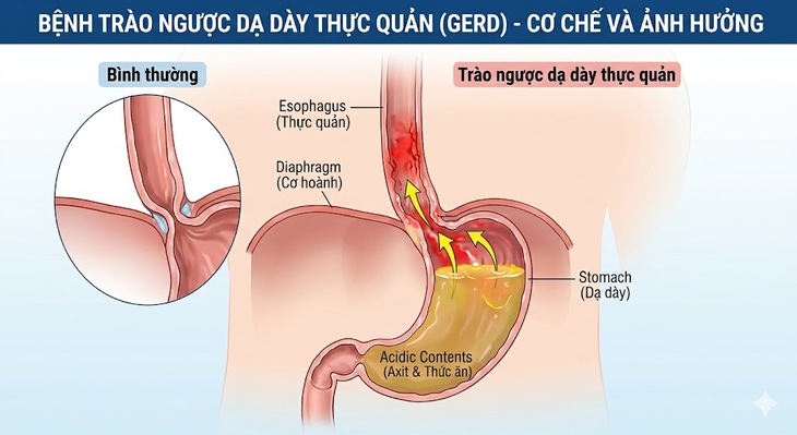 Vì sao người bệnh trào ngược dạ dày không nên dùng bạc hà? - Ảnh 1.