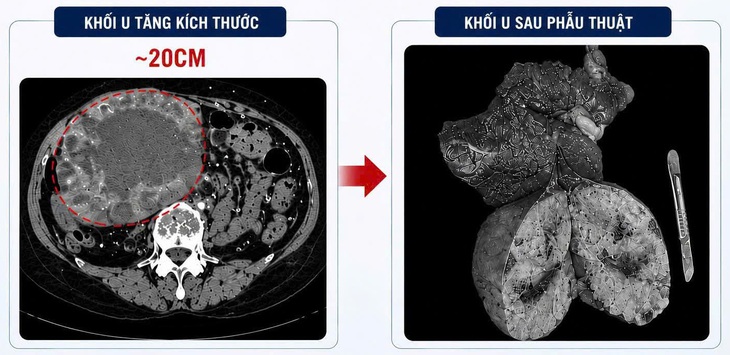 U gan 2 cm 'phình' lên 20 cm do tự điều trị bằng thuốc nam- Ảnh 1. U gan 2 cm 'phình' lên 20 cm do tự điều trị bằng thuốc nam- Ảnh 1.