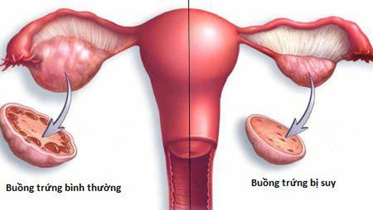 Vô kinh không đồng nghĩa với mãn kinh- Ảnh 1. Vô kinh không đồng nghĩa với mãn kinh- Ảnh 1.