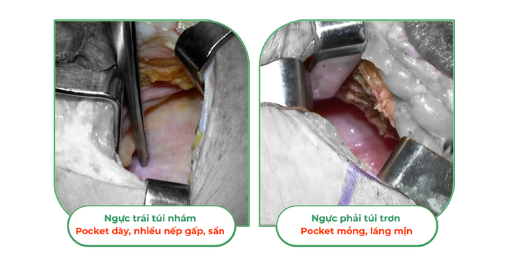 Sự thật khi đặt túi ngực nhám và túi ngực trơn trên cùng 1 cơ thể- Ảnh 1. Sự thật khi đặt túi ngực nhám và túi ngực trơn trên cùng 1 cơ thể- Ảnh 1.