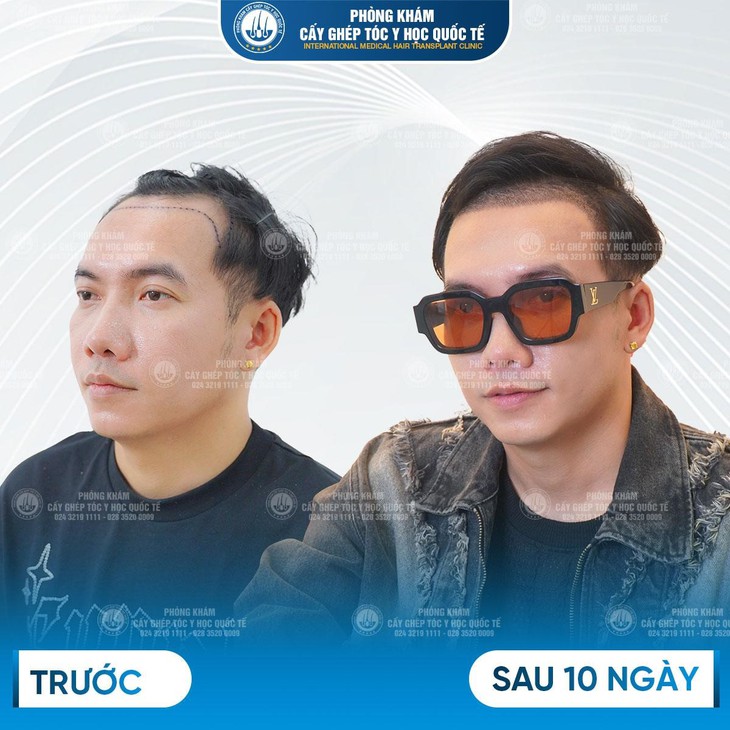 ThS.BS Lê Quang Vương: Cấy tóc tự thân dưới góc độ y khoa - Ảnh 2.