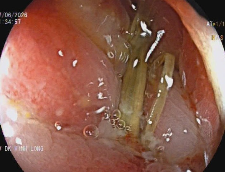Đi cấp cứu vì tiêu ra máu, phát hiện dị vật dài 3cm đâm thủng đại tràng - Ảnh 1.