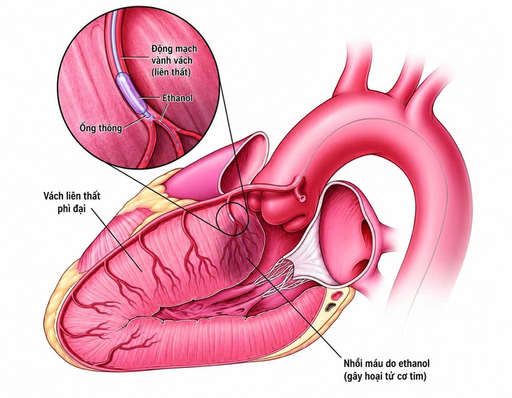 Không cần mổ tim mở, bệnh nhân 76 tuổi điều trị thành công bệnh suy tim- Ảnh 1. Không cần mổ tim mở, bệnh nhân 76 tuổi điều trị thành công bệnh suy tim- Ảnh 1.