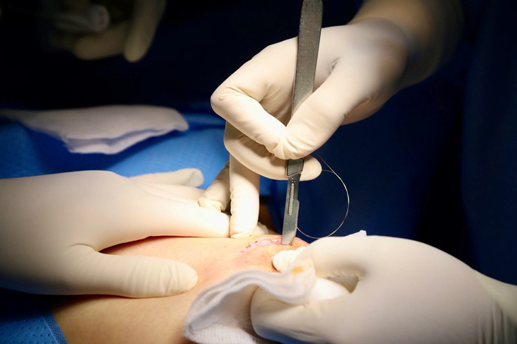 Ứng dụng công nghệ định vị không dây trong 'truy tìm', xử lý ung thư vú giai đoạn sớm- Ảnh 1.