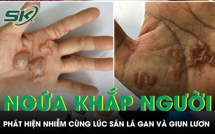 Ghi nhận nhiều người bị giun lươn ở Khánh Hòa, bác sĩ cảnh báo mức độ nguy hiểm nếu không điều trị sớm - Ảnh 3.
