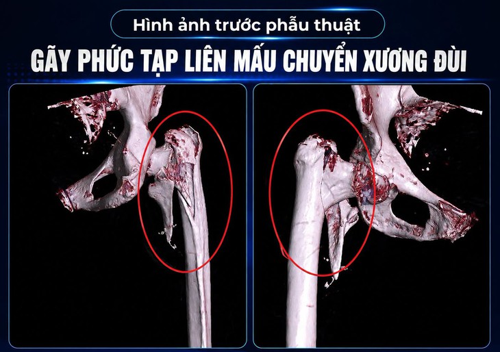 Cứu cụ bà 87 tuổi bị gãy xương đùi phức tạp- Ảnh 1.