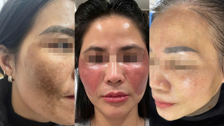 BSCKII Nguyễn Tiến Thành – người đồng hành với những làn da biến chứng nặng- Ảnh 1. BSCKII Nguyễn Tiến Thành – người đồng hành với những làn da biến chứng nặng- Ảnh 1.