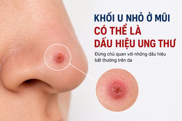 Cảnh báo ung thư da núp bóng những tổn thương tưởng chừng vô hại- Ảnh 1. Cảnh báo ung thư da núp bóng những tổn thương tưởng chừng vô hại- Ảnh 1.