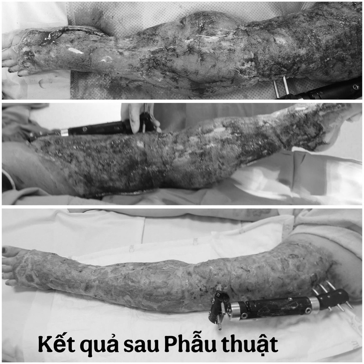 Lóc da sau tai nạn giao thông, cô gái trải qua 4 lần phẫu thuật ghép da - Ảnh 2.