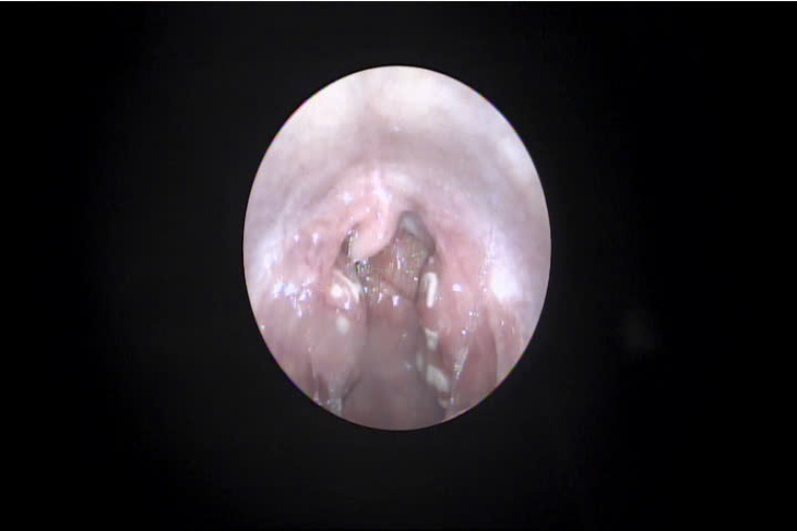Amydan viêm cấp có mủ - trẻ em
