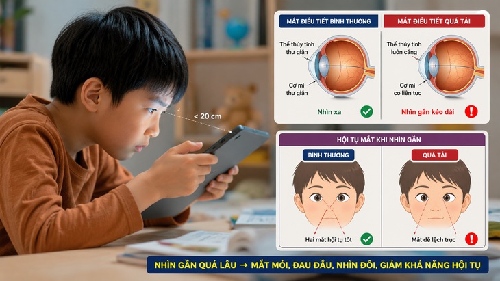 Mắt có nguy cơ lác ẩn do nhìn gần điện thoại và máy tính bảng- Ảnh 1.