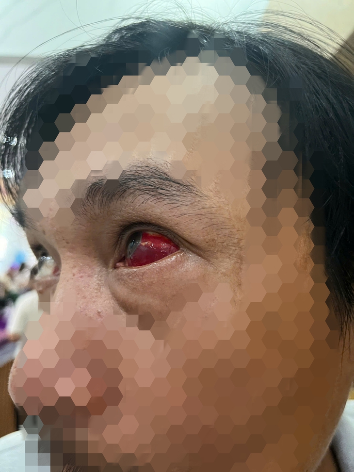 Mắt đỏ ngầu sau khi uống rượu bia, dấu hiệu cảnh báo nguy hiểm- Ảnh 2.