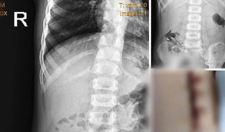 Bệnh viện Sản Nhi Nghệ An làm rõ phản ánh liên quan bệnh nhi nuốt nam châm- Ảnh 1.