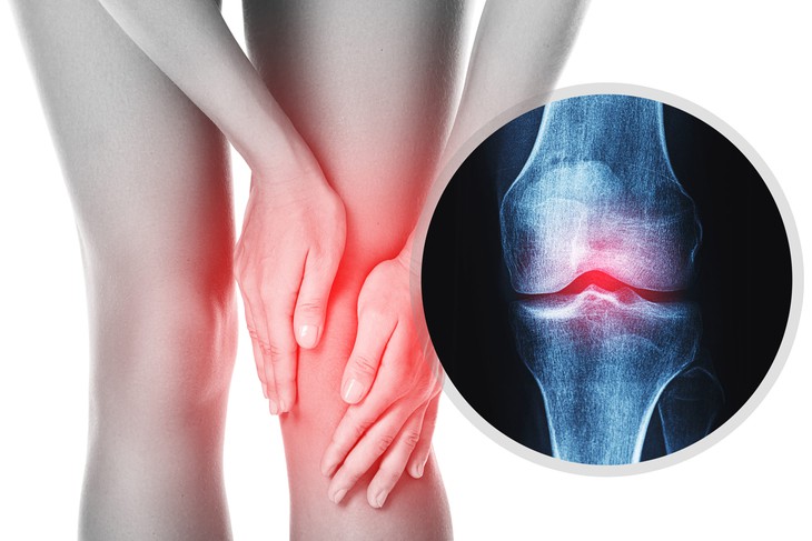 Thoái hóa khớp sẽ được điều trị dứt điểm sau vài tuần chỉ bằng... 1 mũi tiêm?- Ảnh 2.