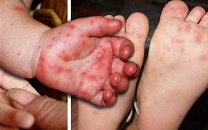 Tay chân miệng tăng nhanh ở Khánh Hòa, bác sĩ khuyến cáo người dân không chủ quan- Ảnh 1.