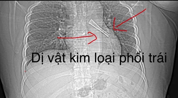 Phát hiện dị vật cán thìa inox trong phế quản sau một tháng ho kéo dài - Ảnh 1.