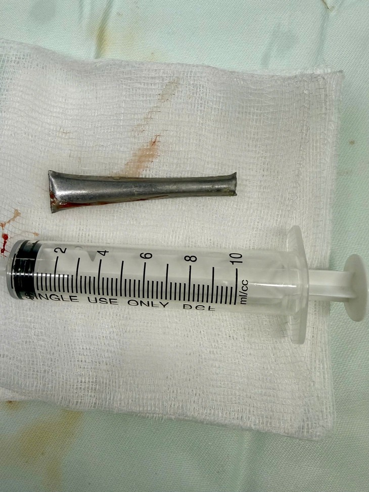 Phát hiện dị vật cán thìa inox trong phế quản sau một tháng ho kéo dài - Ảnh 2.