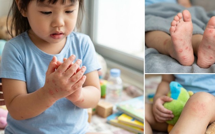 Lâm Đồng siết chặt phòng, chống dịch tay chân miệng sau 2 ca tử vong do nhiễm virus EV71- Ảnh 2.