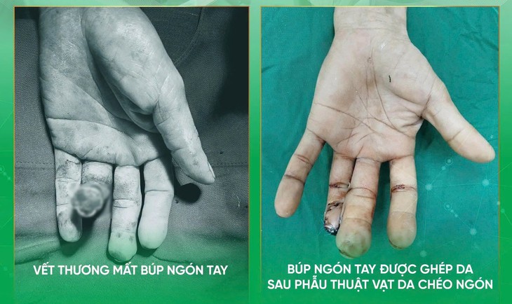 Thêm giải pháp tạo hình cho người bị khuyết hổng đầu ngón tay- Ảnh 1.