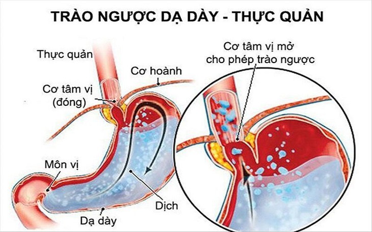 Mẹo chữa nấc cụt tại nhà - Ảnh 1.