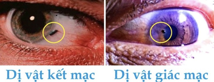 Cảnh báo dị vật mắt khi lao động gây thủng giác mạc- Ảnh 1.