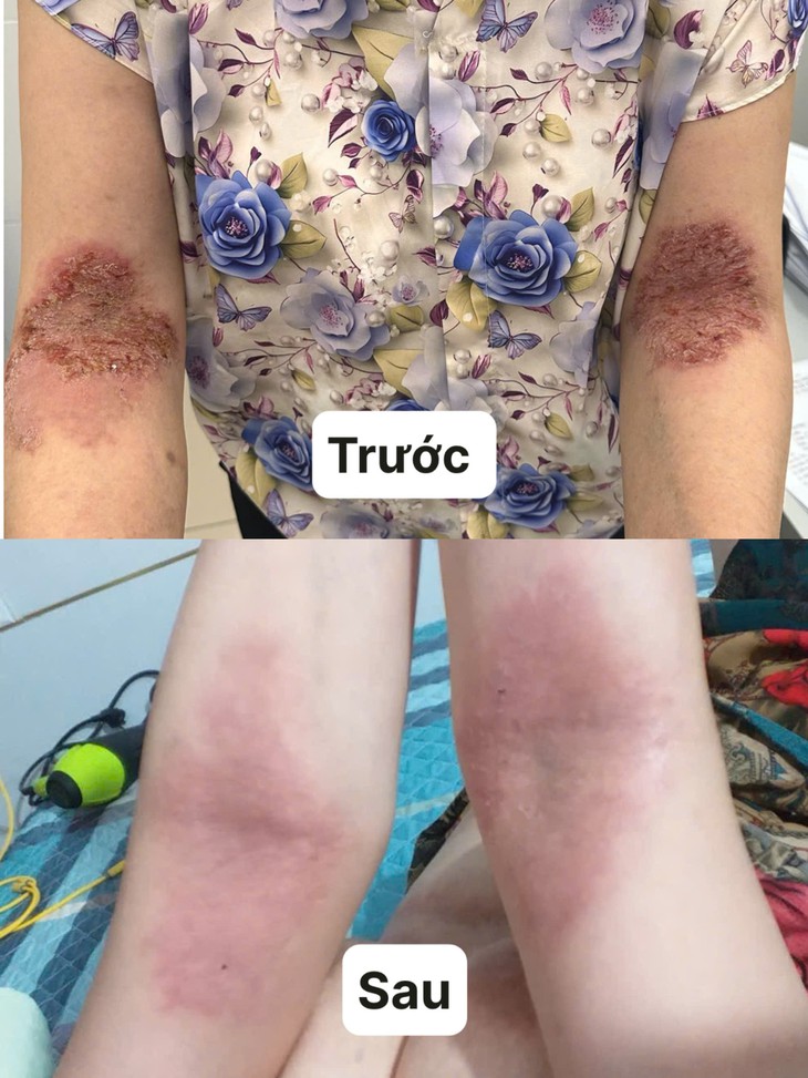 Phác đồ điều trị bệnh Hailey - Hailey tại Bệnh viện giúp người phụ nữ thoát cảnh khổ - Ảnh 1.
