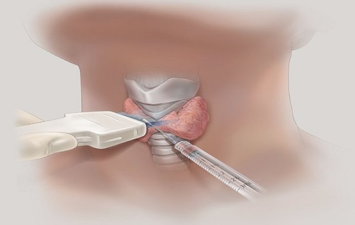 Phát hiện nhân tuyến giáp có nhất thiết phải chọc hút tế bào?- Ảnh 2.