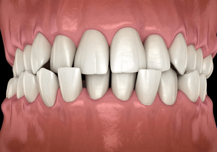 10 dấu hiệu cần chỉnh nha sớm ở trẻ em, đừng đợi đến khi con mọc đủ răng mới đi khám- Ảnh 1.