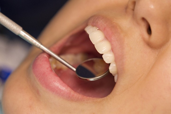 Vi khuẩn thường gặp trong miệng có thể là 'thủ phạm' âm thầm gây hẹp van tim?- Ảnh 4.